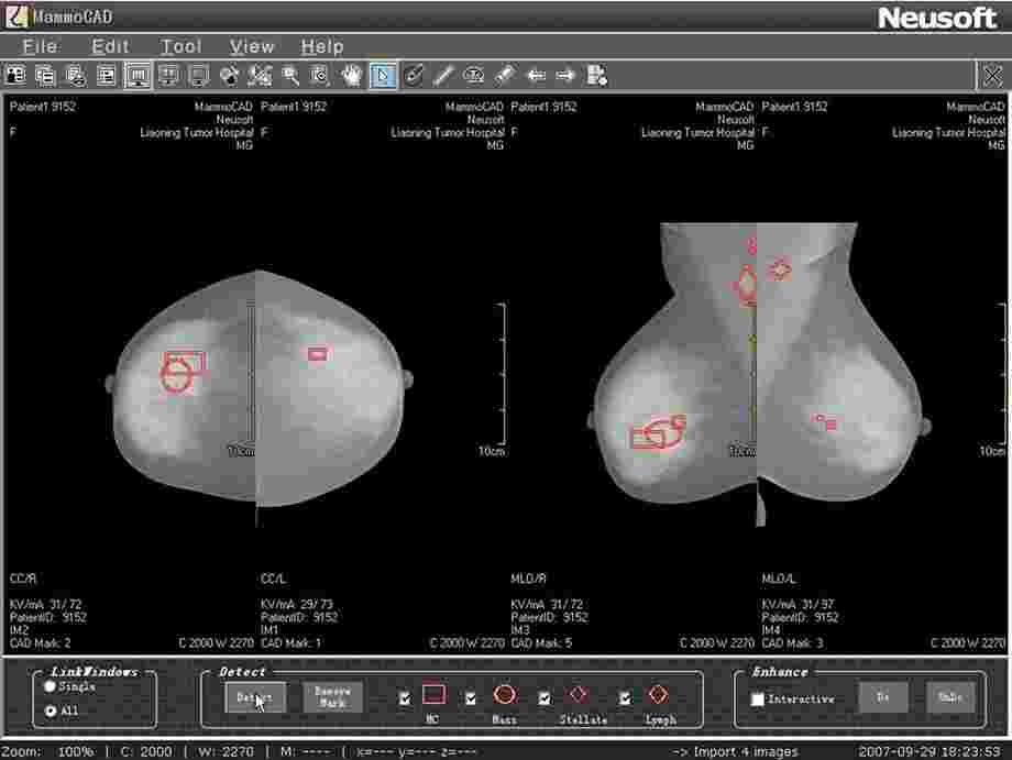 从人工智能在乳腺筛查中的应用看医疗热点的投资逻辑