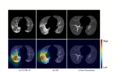 【首发】AI科技抗击新冠｜科亚医疗在《Radiology》首个发表基于人工智能的新冠诊断准确性评估论文