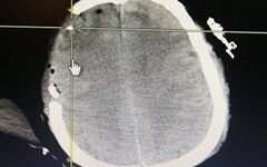 拓蓝医疗颅内压监护仪和颅内压传感器顺利完成首例临床