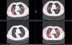 柏视医疗与RADlogics建立战略合作关系，共拓AI医学影像新格局