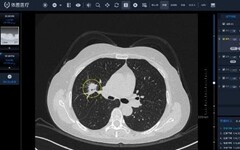 AI如何赋能呼吸影像？广医附一临床试验结果重磅发布