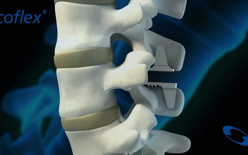 RTI Surgical宣布以3亿美元收购Paradigm Spine，以拓展自己的脊柱业务