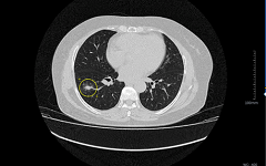 1277名志愿者中查出22例疑似肺癌，“AI防癌地图”是如何做到的？