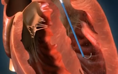 投入1亿美元不够，Abiomed继续开发微型“人工心脏”Impella临床组合