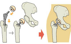 人工关节行业研究报告